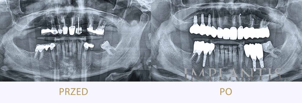 Zęby przed i po leczeniu: Kompleksowa rehabilitacja: implanty, mosty, korony