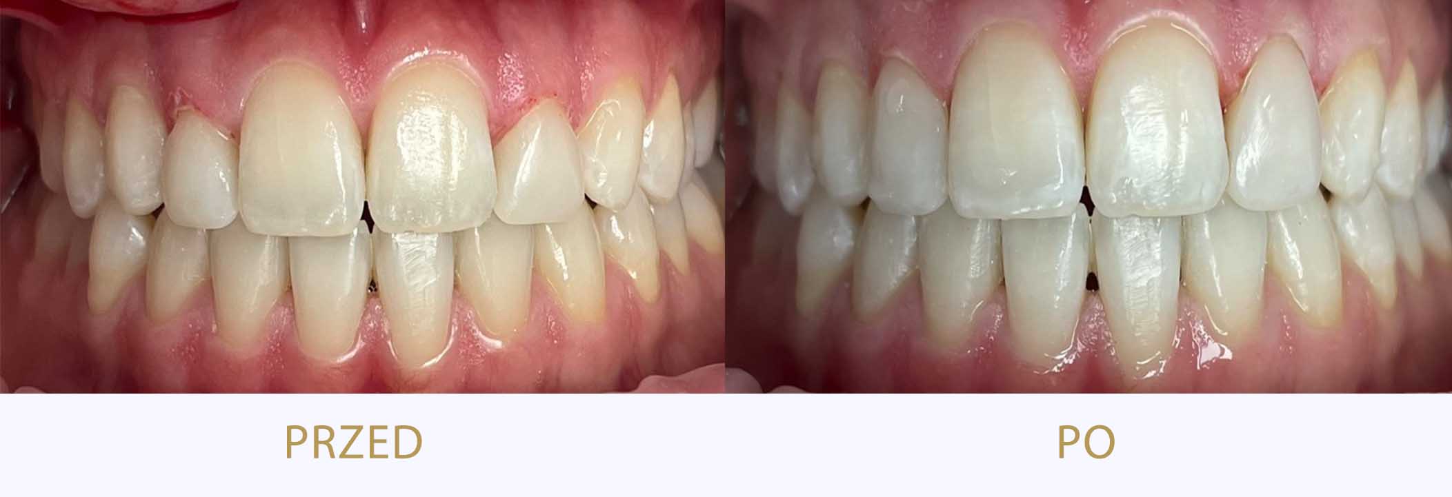 zęby przed i po leczeniu: korekta dziąseł