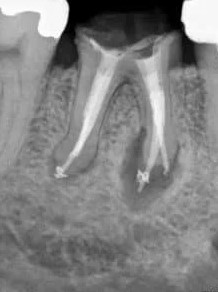 Rentgenowskie zdjęcie zęba po leczeniu kanałowym.