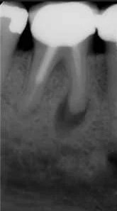 Zdjęcie rentgenowskie przed leczeniem kanałowym - zębów człowieka.